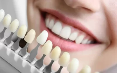 Lente de contato dental
