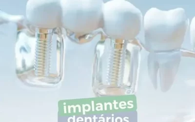 Implantes dentários