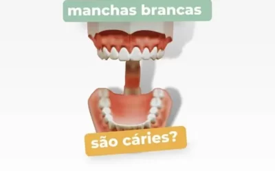 Manchas brancas são cáries