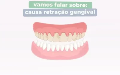 Vamos falar sobre: causa retração gengival