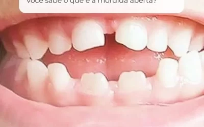 Você sabe o que é mordida aberta?